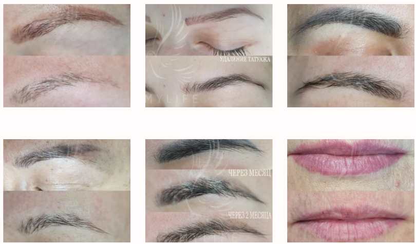 удаление татуажа